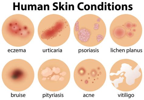 2,500+ Rash Skin Condition Stock Illustrations, Royalty-Free Vector Graphics & Clip Art - iStock