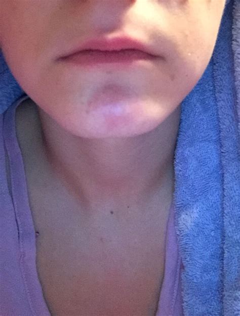 what is this hard red lump on my chin - Rosacea & facial redness - Acne.org