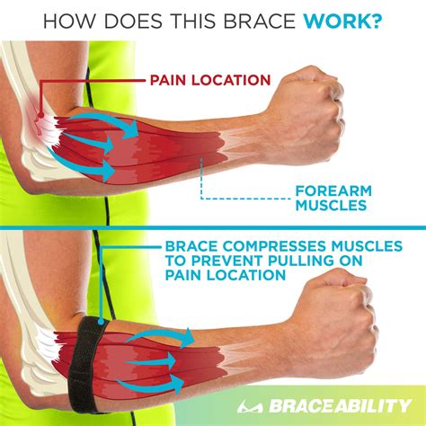 Epicondylitis Brace | Elbow Strap for Medial & Lateral Epicondyle Pain