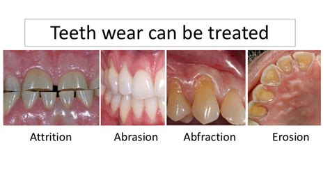 What is Tooth wear? - Leading Dental Clinic in Dubai - Best Dentist ...