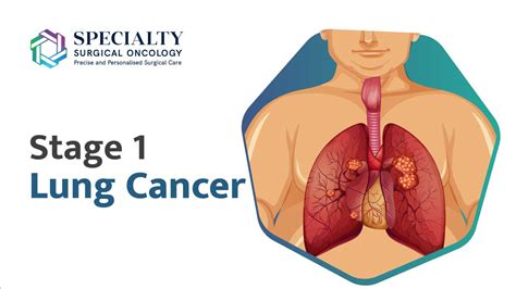 Stage 1 Lung Cancer: Signs, Symptoms, Diagnosis and Treatment