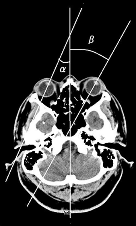 Radiographic conjugate horizontal eye deviation in patients with acute cerebellar infarction ...