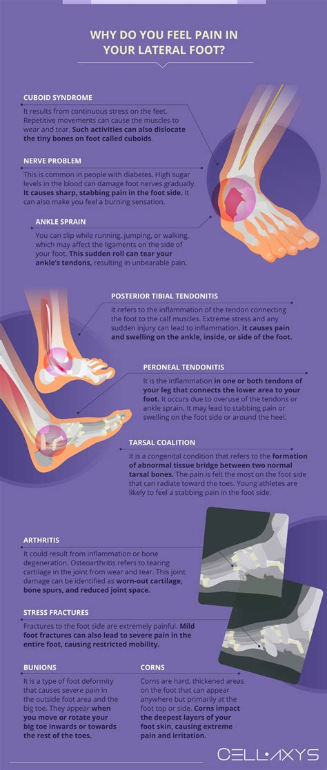 10 Causes Of Stabbing Pain In Foot Side - Cellaxys