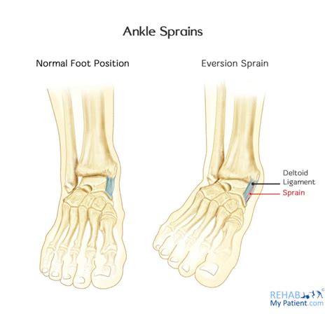 Medial Ankle Sprain Motus Physical Therapy, 53% OFF