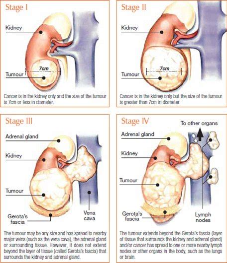 OHC Kidney Cancer Stage 1, 2, 3, 4 - OHC - Oncology Hematology Care