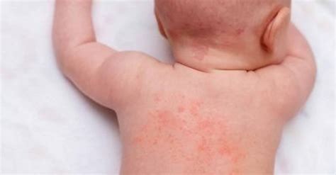 Heat Rash On Baby - Causes And Treatment | BellyBelly