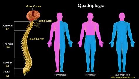 HEMIPLEGIA AND HOMEOPATHY - EXPERT HOMEOPATHY