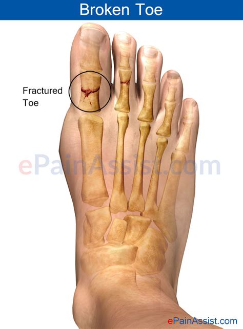 Broken Toe or Fractured Toe|Treatment|Symptoms|Recovery|Prognosis