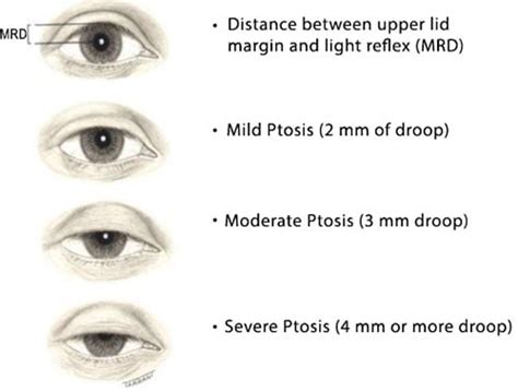 Sagging Eye Syndrome: Causes, Symptoms, Diagnosis & Treatment - Daily Medicos