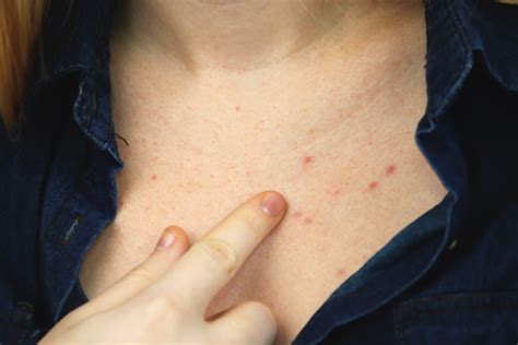 Chest Acne: What Causes It and How To Get Rid of It