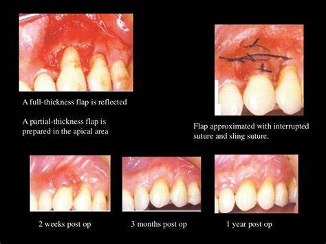 Mucogingival surgery