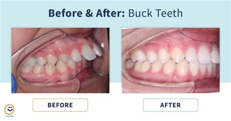 Braces: Before and After Buck Teeth