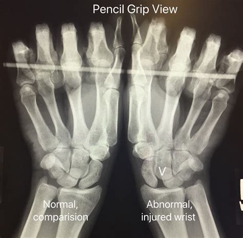 Scapholunate Ligament Injury - John Erickson, MD