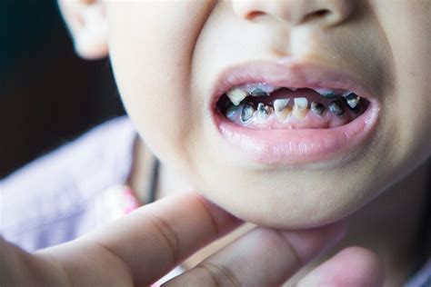 Tips to Prevent Tooth Decay in Kids | Kakar Dental Group