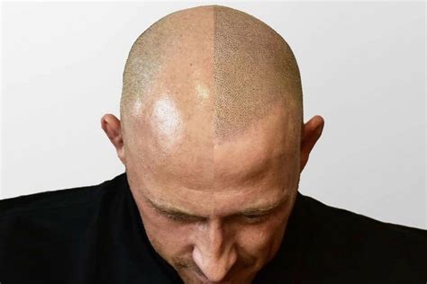 Scalp Micropigmentation Hairline Tattoo, What You Need To Know