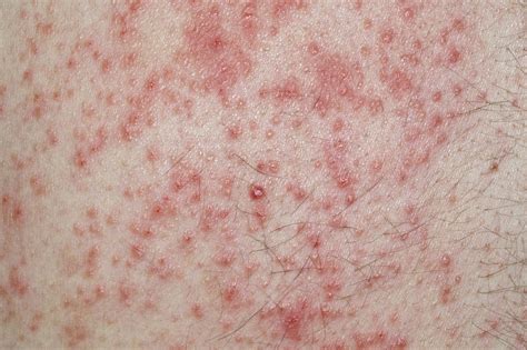 Contact dermatitis - NHS