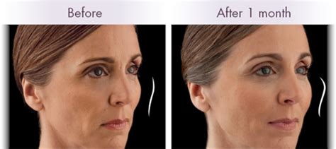 Voluma Injectable Filler | Camarillo CA