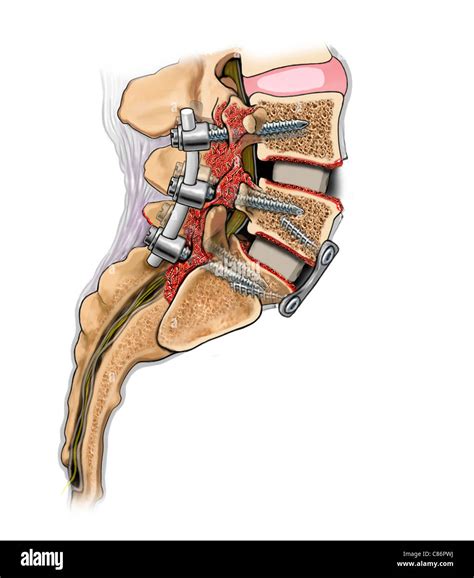 Lumbar Bone Fusion of L4-S1 Stock Photo, Royalty Free Image: 39487662 - Alamy