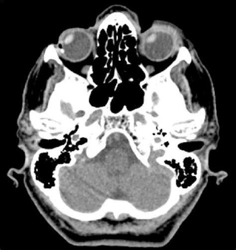 Non-contrast computed tomography (CT) scan showing conjugate eye... | Download Scientific Diagram