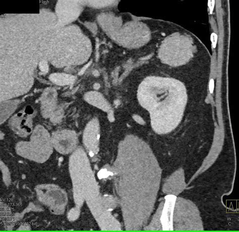 Multiple Accessory Spleens in Patient s/p Splenectomy - Spleen Case Studies - CTisus CT Scanning