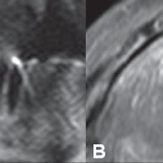 year-old woman with periapical cyst. Cropped panoramic radiograph shows... | Download Scientific ...