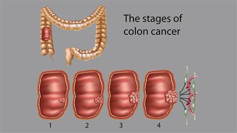 Living With a Colostomy After Colon Cancer - Colon Cancer Center - EverydayHealth.com