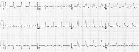 Right Bundle Branch Block (RBBB) • LITFL • ECG Library Diagnosis