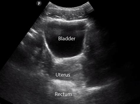 Normal Bladder Ultrasound