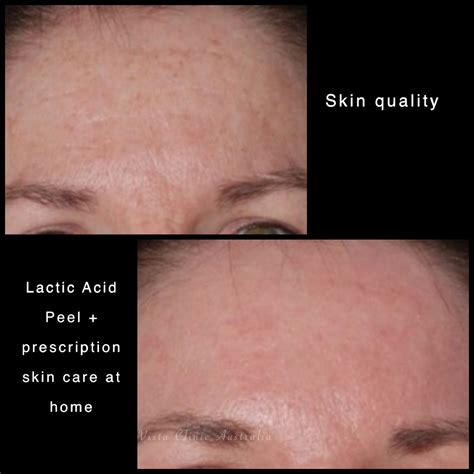 Lactic Acid Peel Before After