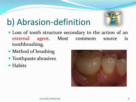 PPT - Tooth wear: aetiology , prevention, clinical implication ...