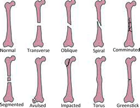 The Types of Fractures Children Have and How to Treat Them