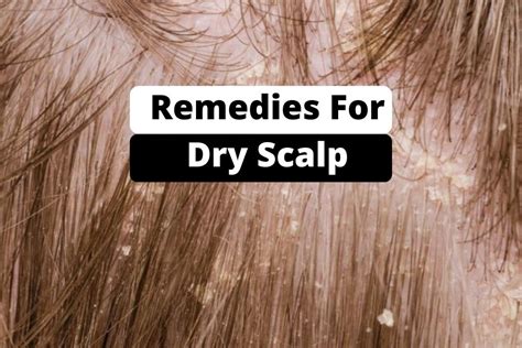 Home Remedies for Dry Scalp - Go Lifestyle Wiki