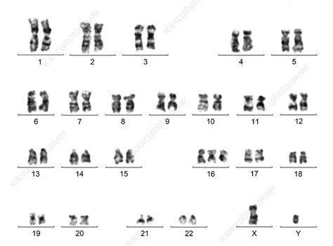 Trisomy 9 Complete