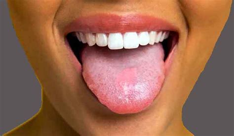 Tongue Diseases | Smile Centre India