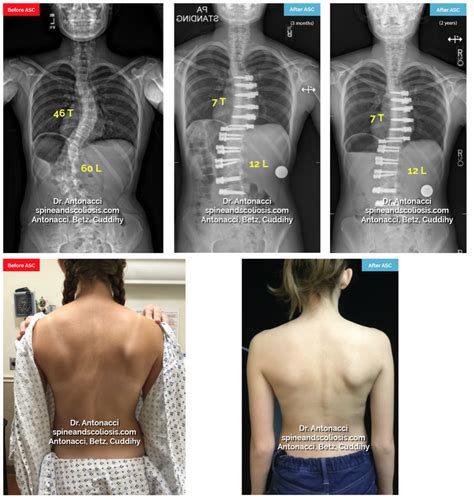 Before and After Scoliosis Surgery with Darryl Antonacci