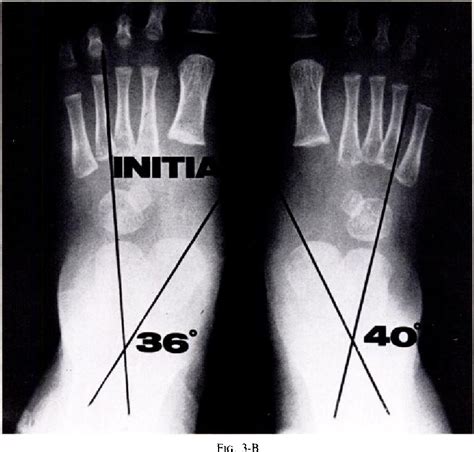 Talipes Calcaneovalgus | Semantic Scholar