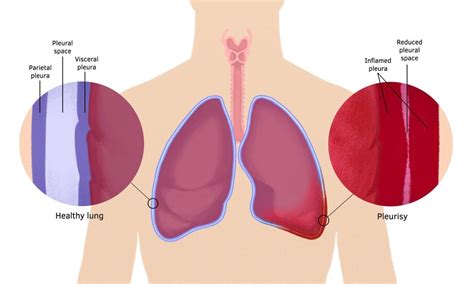 Learning Pleurisy: Symptoms, Causes, Diagnosis and Treatment - Health Sarthi