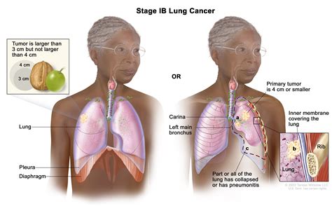 Non-Small Cell Lung Cancer Treatment (PDQ®) - NCI