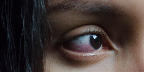 What Exactly Causes Red Eyes That Look All Bloodshot? | SELF