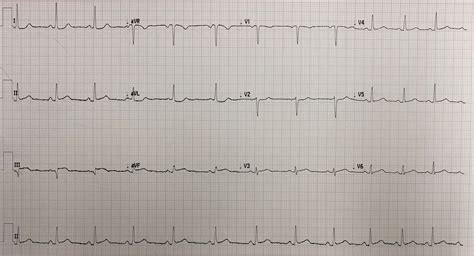 Dr. Smith's ECG Blog: This patient with "NSTEMI" was not allowed to go to the cath lab. Then the ...