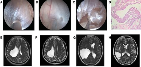 Neuroendoscopic treatment to intracranial arachnoid cyst. (A) Lateral ...