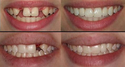 dental-implant-before-and-after - Dr George DDS