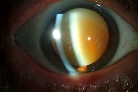 Hypermature Cataract: Meaning, Signs, Causes, Effects, Treatment