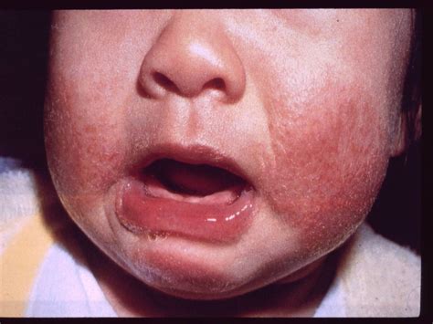 Eczema in Children | National Eczema Association