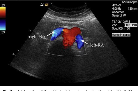 Renal Doppler Ultrasound