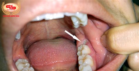 What to do to reduce pain quickly when wisdom teeth growing?