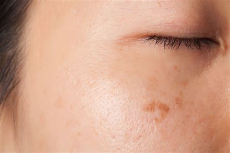 What Causes Brown Spots on the Skin? - Beverly Hills MD