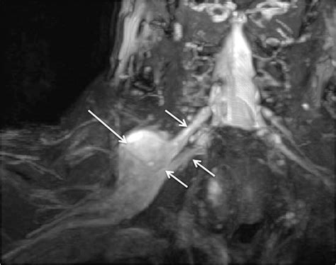 Anatomy - Brachial Plexus | Geeky Medics