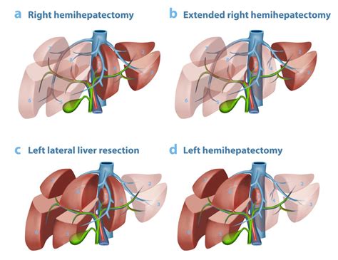 Liver Treatment - Liver Surgery | Perth Liver Specialists & Surgeons