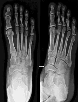 Tarsal fracture undisplaced | CUH